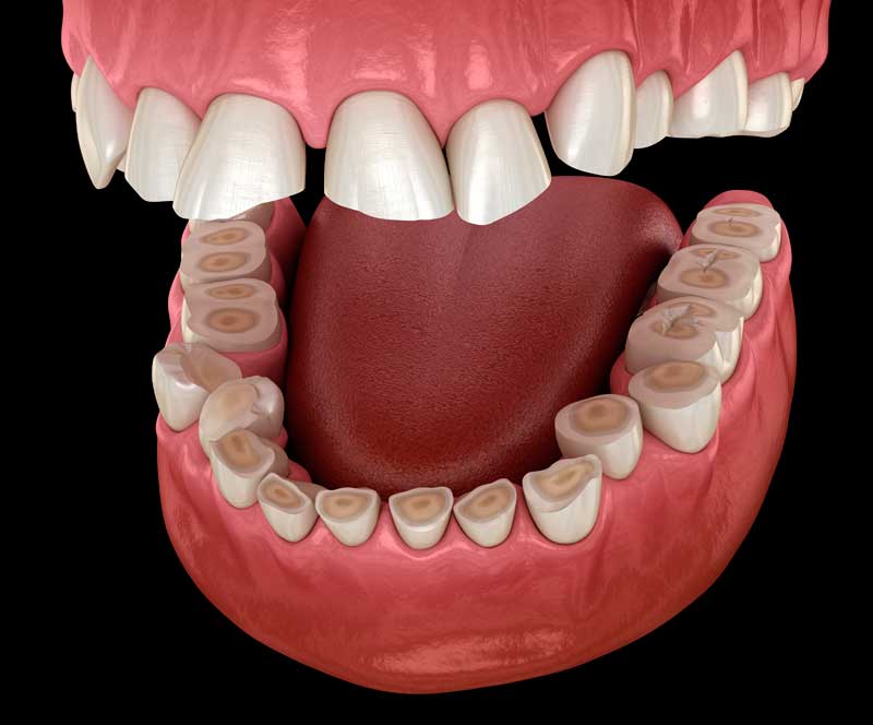 Aprietas los dientes? Conoce sobre el Bruxismo dental - Clínica Dental  Gramadent