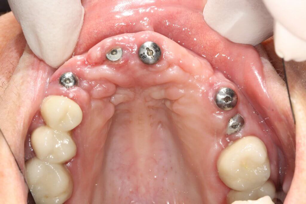 multa condensador cansado Implante dental en Pinto - Franqueza dental Implantes de calidad